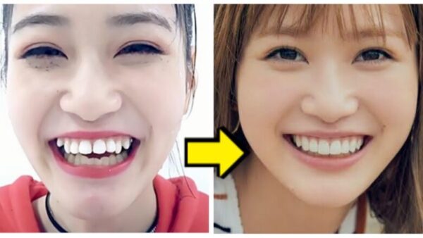 めるるの歯列矯正前と後の歯の変化