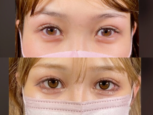 浦西ひかるの目の二重整形前と後の比較画像